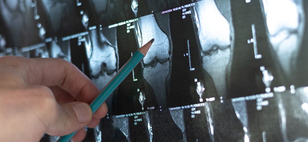 impacto dos microplásticos nos ossos