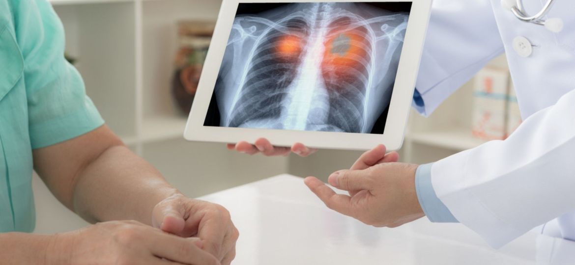cancro do pulmão