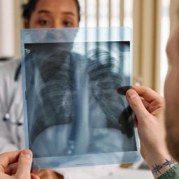 doenças pulmonares intersticiais