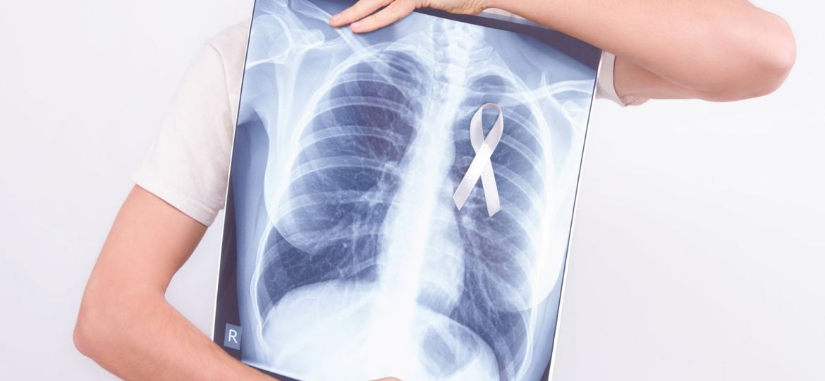 cancro do pulmão