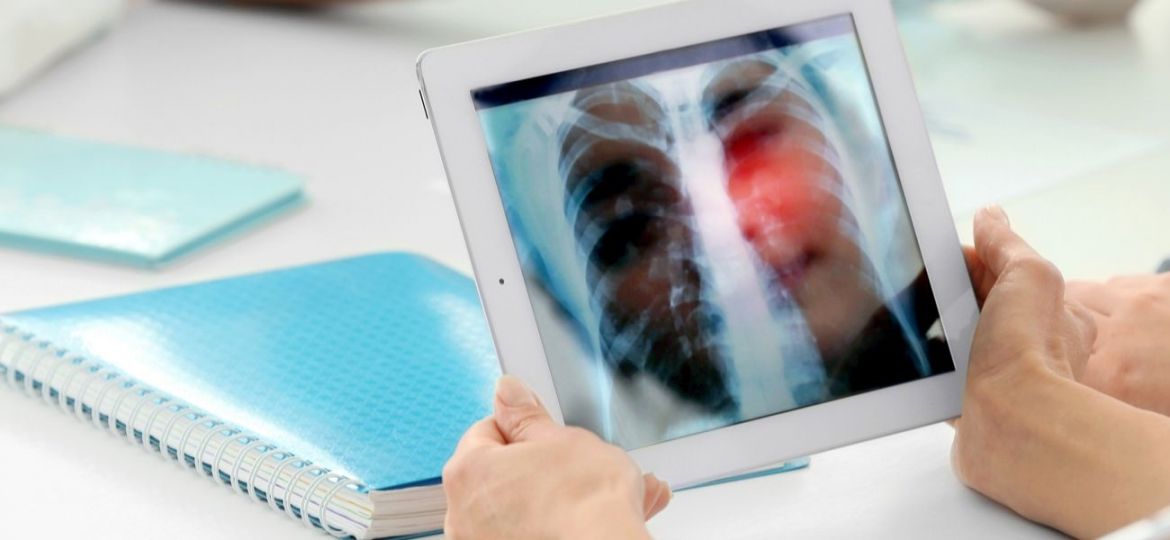 doenças intersticiais pulmonares