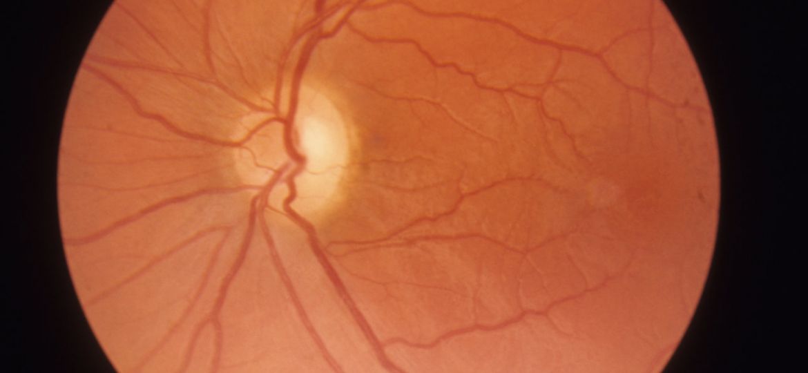 imagem técnica da retina de lhon