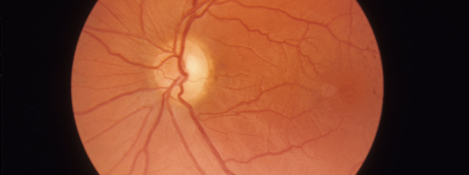 imagem técnica da retina de lhon