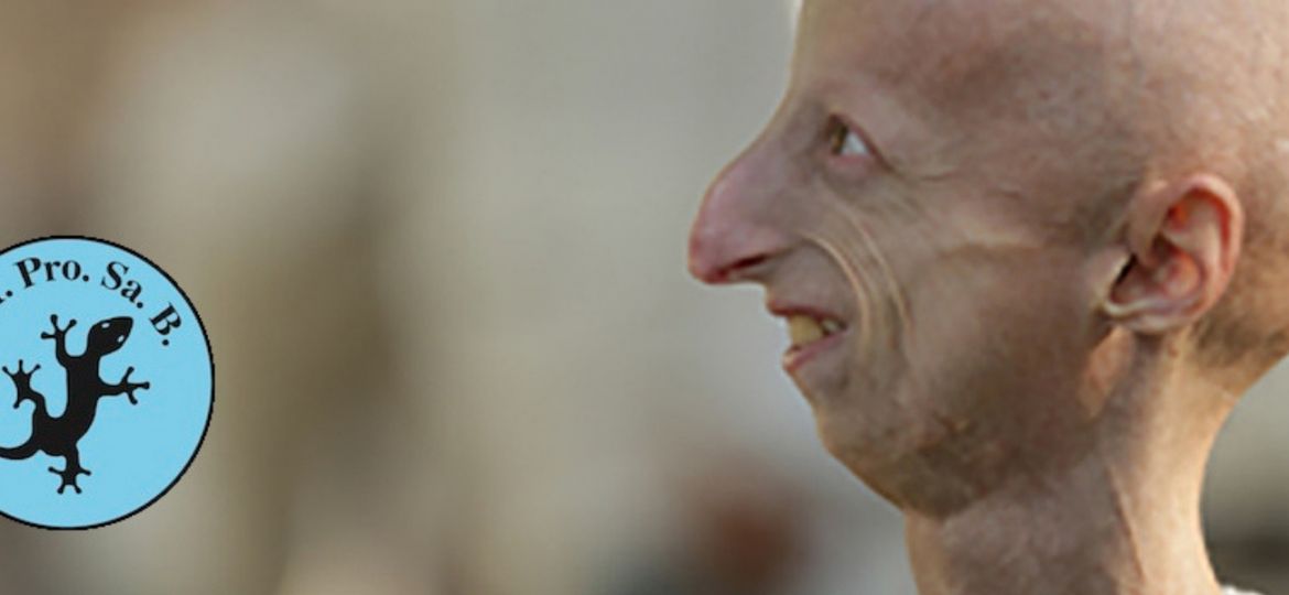 progeria, envelhecimento precoce