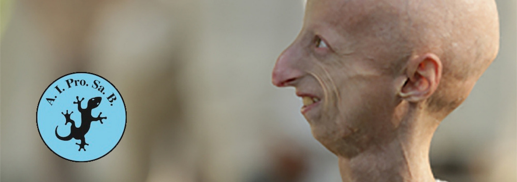 progeria, envelhecimento precoce