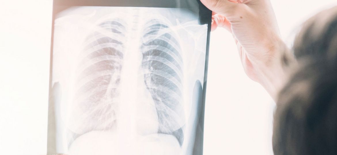 casos de tuberculose