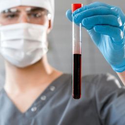 Biomarcadores para Alzheimer