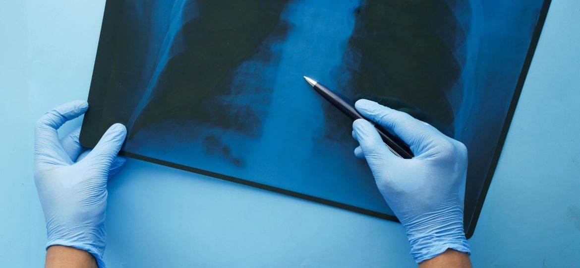 Doenças do Interstício Pulmonar