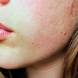 eczema atópico e saúde mental