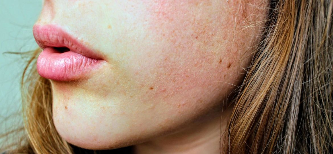eczema atópico e saúde mental