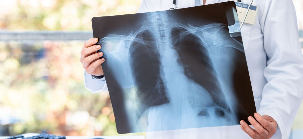 tuberculose nos homens